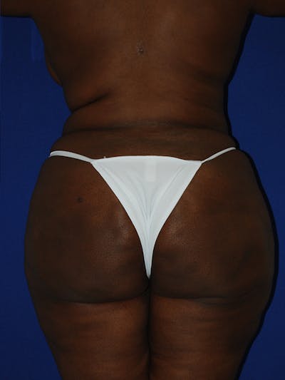 Avéli Cellulite Treatment Before & After Gallery - Patient 176456 - Image 2