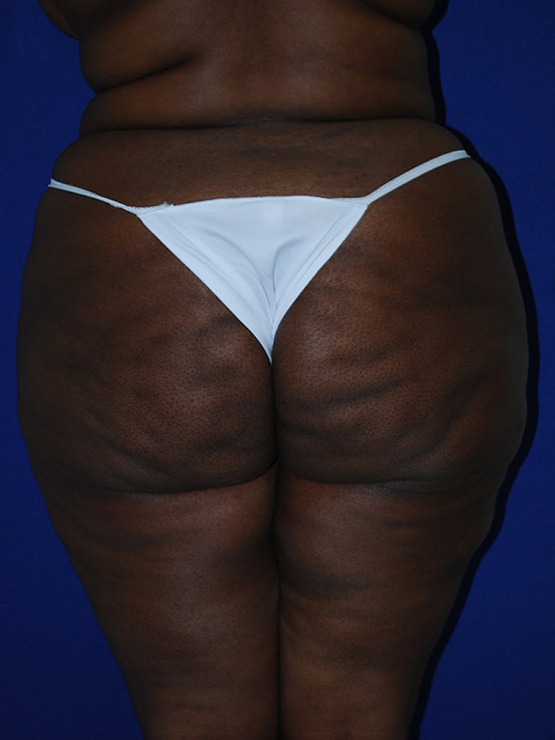 Avéli Cellulite Treatment Before & After Gallery - Patient 176456 - Image 3