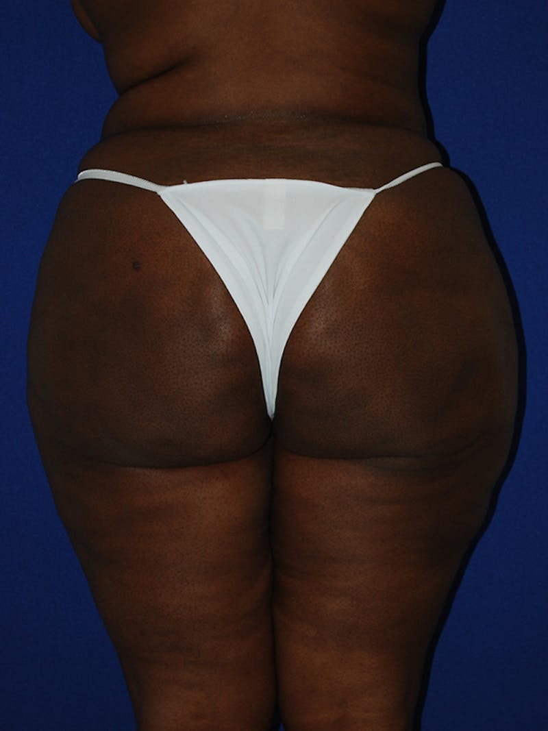 Avéli Cellulite Treatment Before & After Gallery - Patient 176456 - Image 4