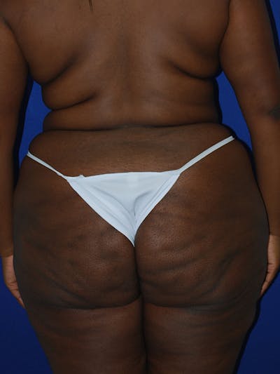 Avéli Cellulite Treatment Before & After Gallery - Patient 176456 - Image 1