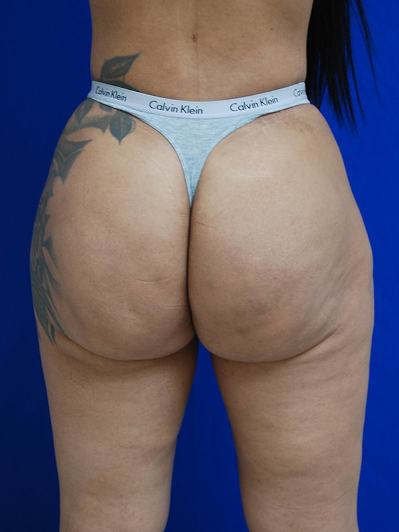 Avéli Cellulite Treatment Before & After Gallery - Patient 326728 - Image 2