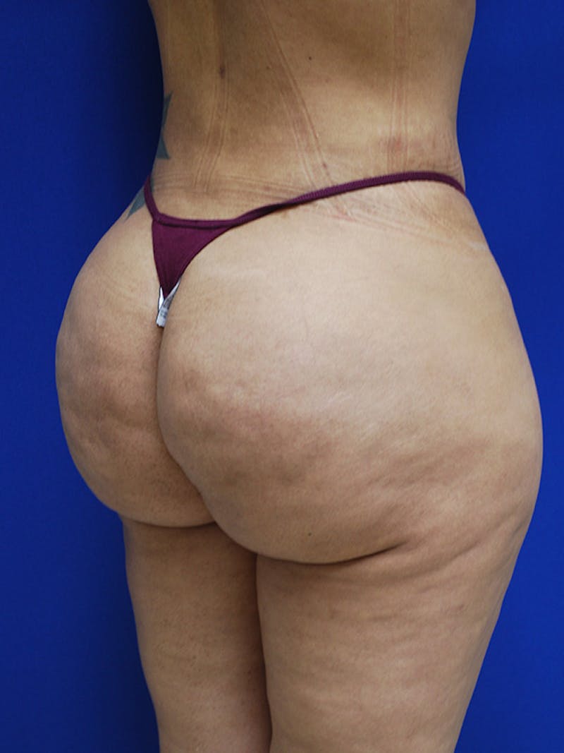 Avéli Cellulite Treatment Before & After Gallery - Patient 326728 - Image 5