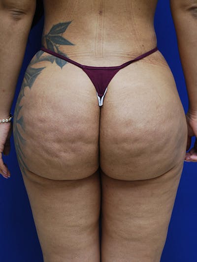 Avéli Cellulite Treatment Before & After Gallery - Patient 326728 - Image 1