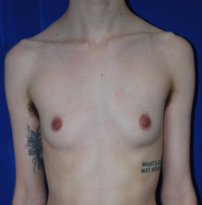 Reduction Before & After Gallery - Patient 609770 - Image 1