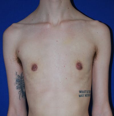 Reduction Before & After Gallery - Patient 609770 - Image 2