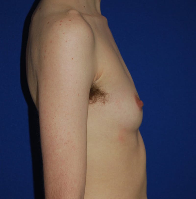 Reduction Before & After Gallery - Patient 609770 - Image 3