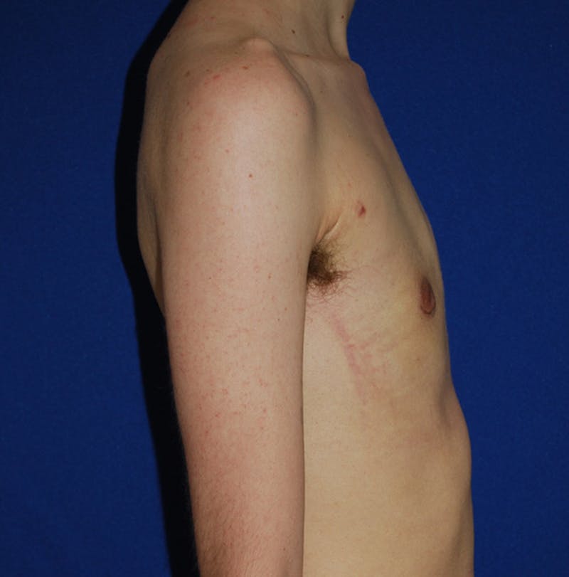 Reduction Before & After Gallery - Patient 609770 - Image 4