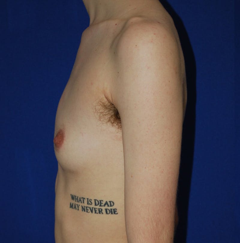 Reduction Before & After Gallery - Patient 609770 - Image 5