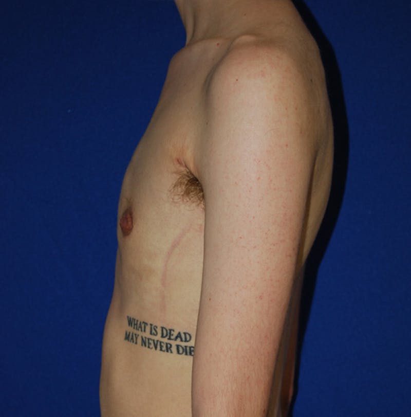 Reduction Before & After Gallery - Patient 609770 - Image 6