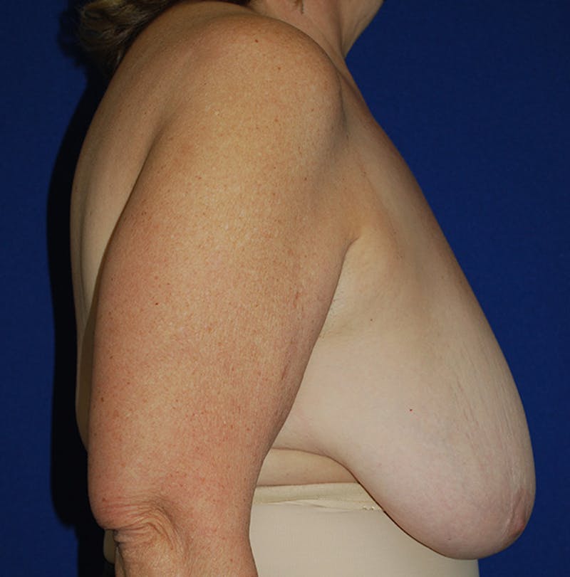 Reduction Before & After Gallery - Patient 321974 - Image 3