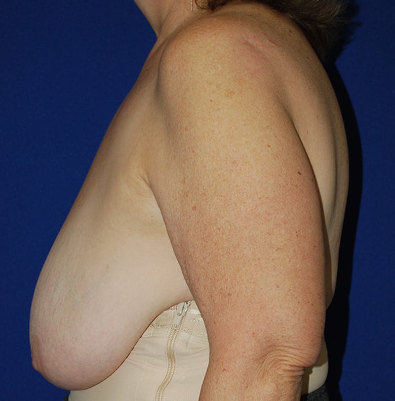 Reduction Before & After Gallery - Patient 321974 - Image 5