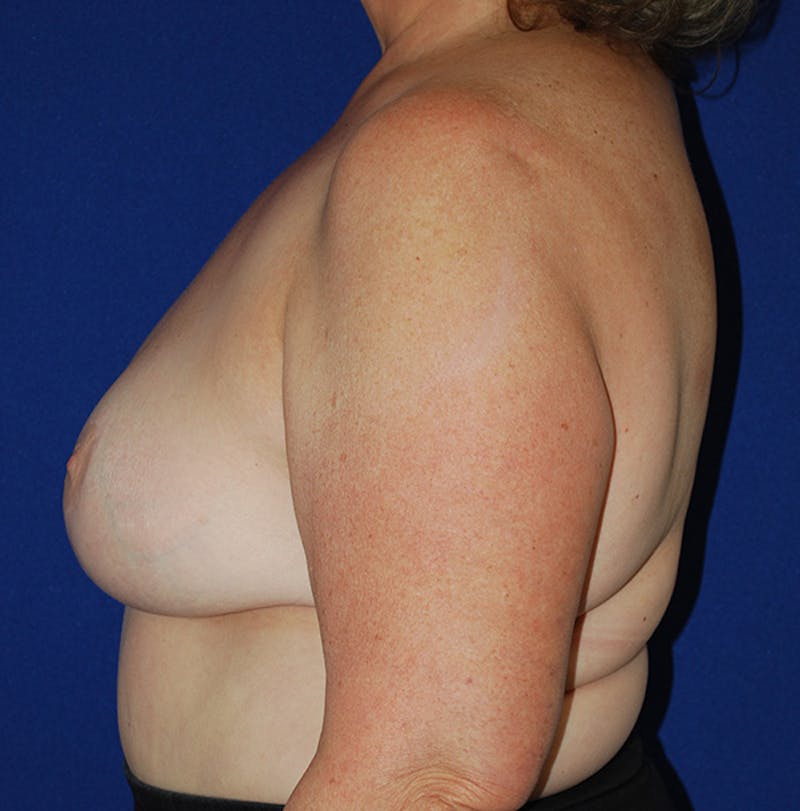 Reduction Before & After Gallery - Patient 321974 - Image 6