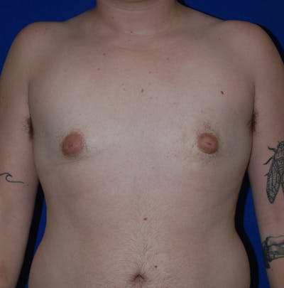 Reduction Before & After Gallery - Patient 167098 - Image 2