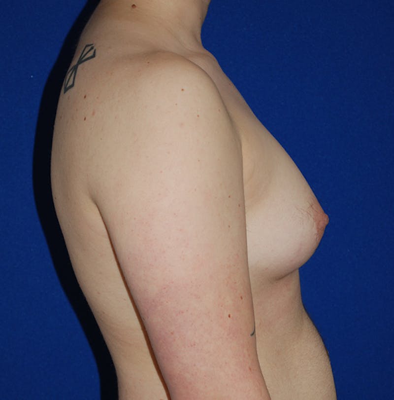 Reduction Before & After Gallery - Patient 167098 - Image 3