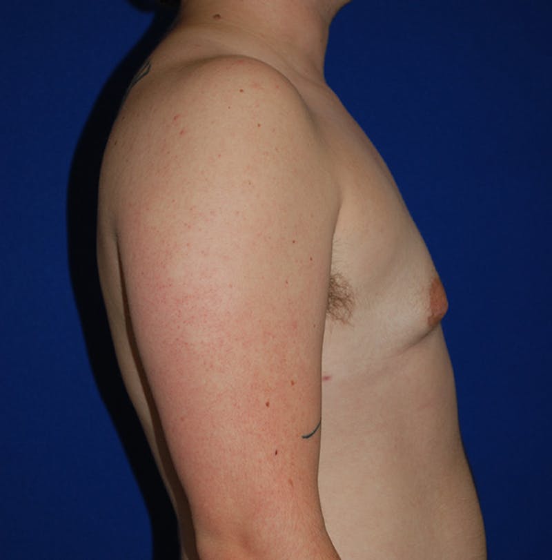 Reduction Before & After Gallery - Patient 167098 - Image 4