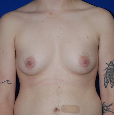 Reduction Before & After Gallery - Patient 167098 - Image 1