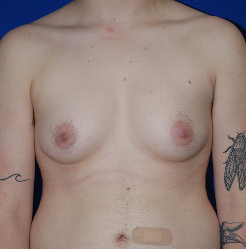 Reduction Before & After Gallery - Patient 167098 - Image 1