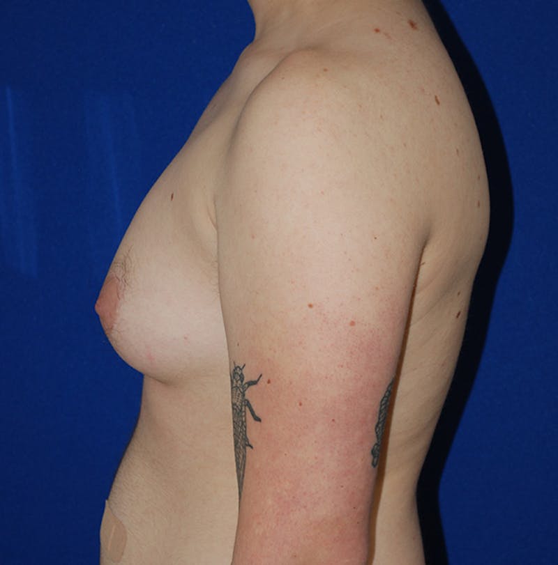 Reduction Before & After Gallery - Patient 167098 - Image 5