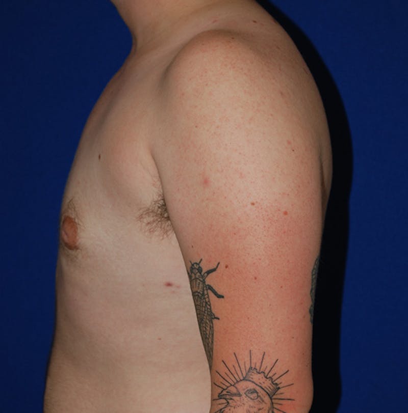Reduction Before & After Gallery - Patient 167098 - Image 6