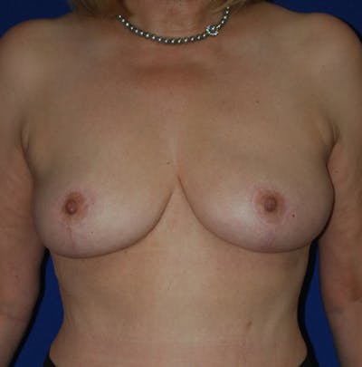 Reduction Before & After Gallery - Patient 374993 - Image 2