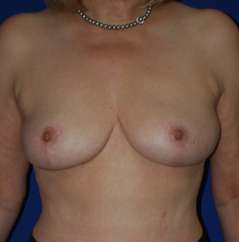 Reduction Before & After Gallery - Patient 374993 - Image 2