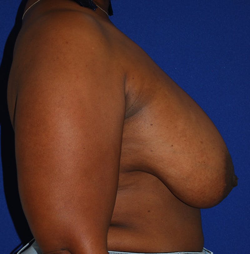 Reduction Before & After Gallery - Patient 105914 - Image 3