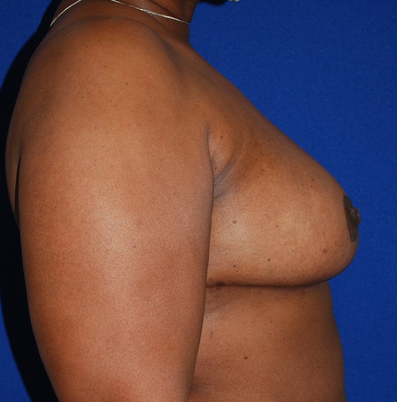 Reduction Before & After Gallery - Patient 105914 - Image 4