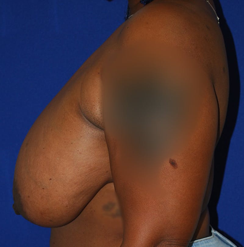 Reduction Before & After Gallery - Patient 105914 - Image 5