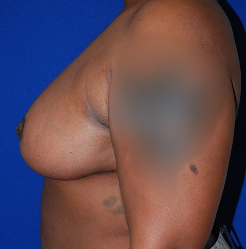 Reduction Before & After Gallery - Patient 105914 - Image 6