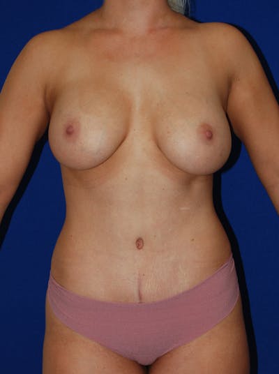 Mommy Makeover Before & After Gallery - Patient 302877 - Image 2