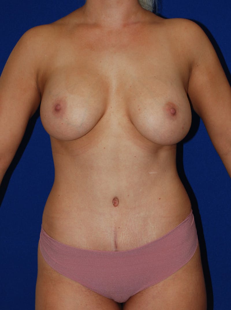 Mommy Makeover Before & After Gallery - Patient 302877 - Image 2
