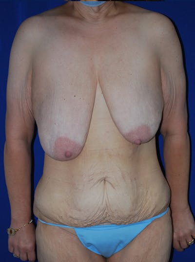 Mommy Makeover Before & After Gallery - Patient 249891 - Image 1