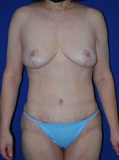 Mommy Makeover Before & After Gallery - Patient 249891 - Image 2