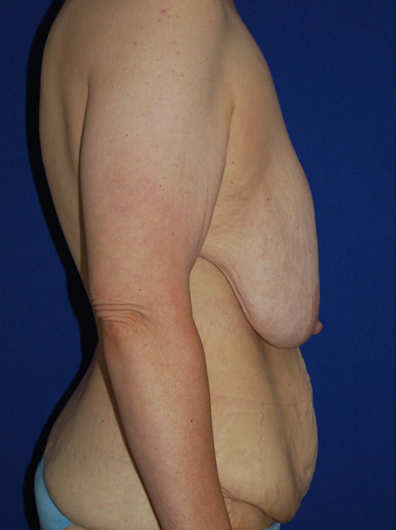 Mommy Makeover Before & After Gallery - Patient 249891 - Image 3