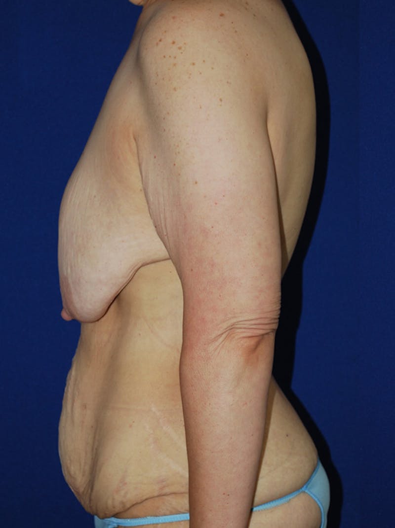 Mommy Makeover Before & After Gallery - Patient 249891 - Image 5