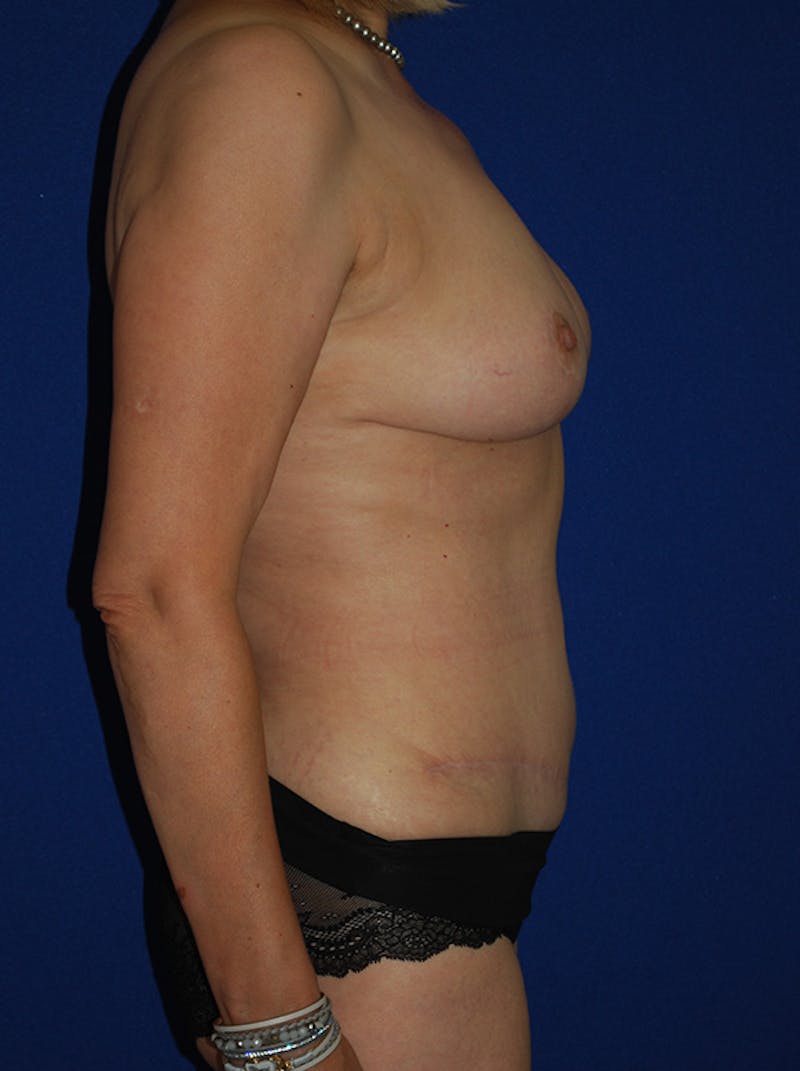Mommy Makeover Before & After Gallery - Patient 350116 - Image 4