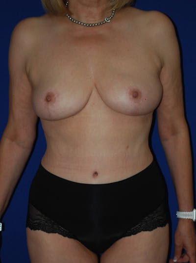 Mommy Makeover Before & After Gallery - Patient 350116 - Image 2