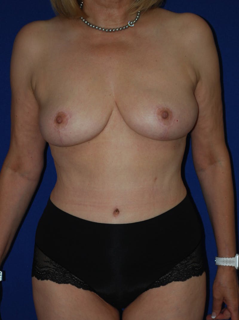 Mommy Makeover Before & After Gallery - Patient 350116 - Image 2