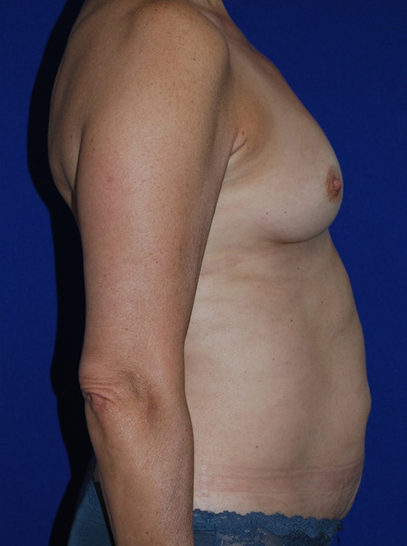 Mommy Makeover Before & After Gallery - Patient 267700 - Image 3