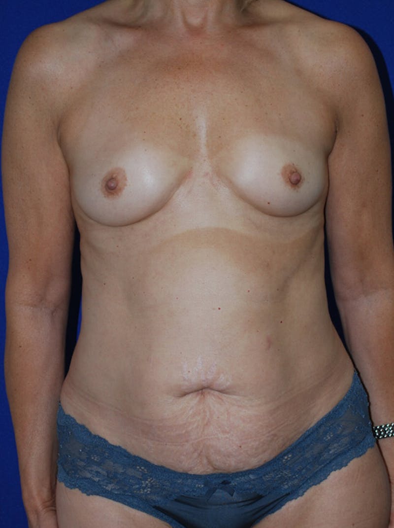 Mommy Makeover Before & After Gallery - Patient 267700 - Image 1