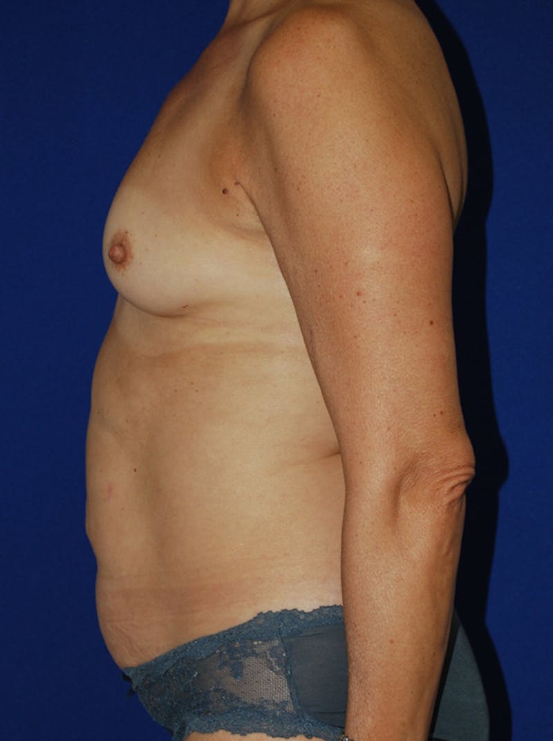 Mommy Makeover Before & After Gallery - Patient 267700 - Image 5