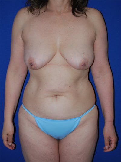 Mommy Makeover Before & After Gallery - Patient 167676 - Image 1