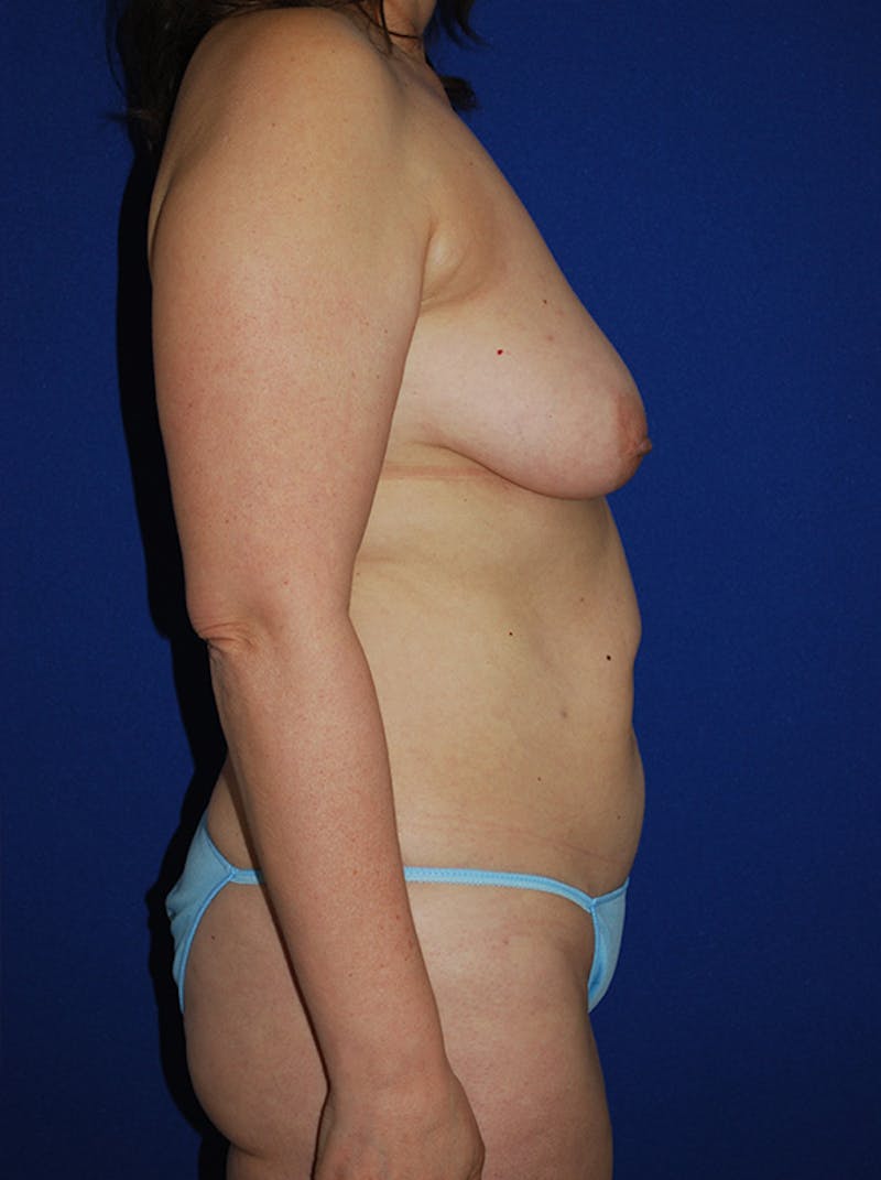 Mommy Makeover Before & After Gallery - Patient 167676 - Image 3