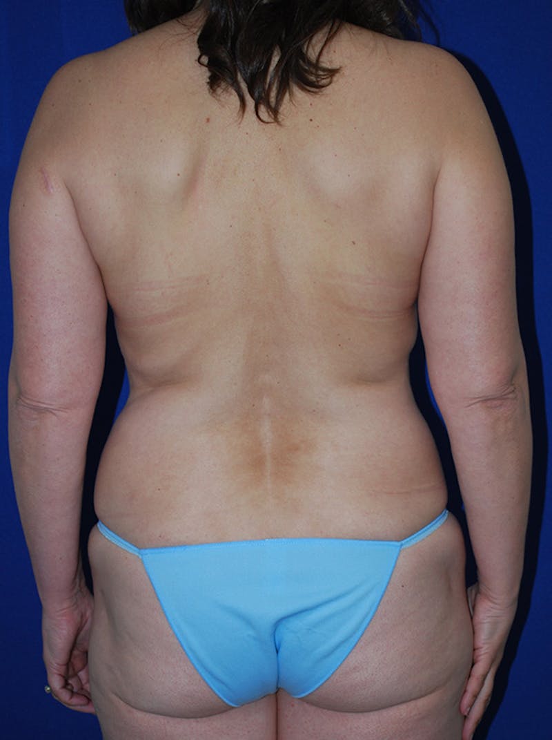 Mommy Makeover Before & After Gallery - Patient 167676 - Image 5