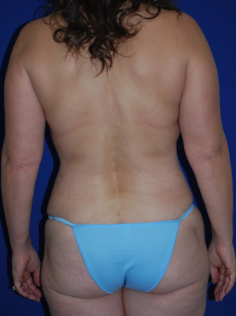Mommy Makeover Before & After Gallery - Patient 167676 - Image 6