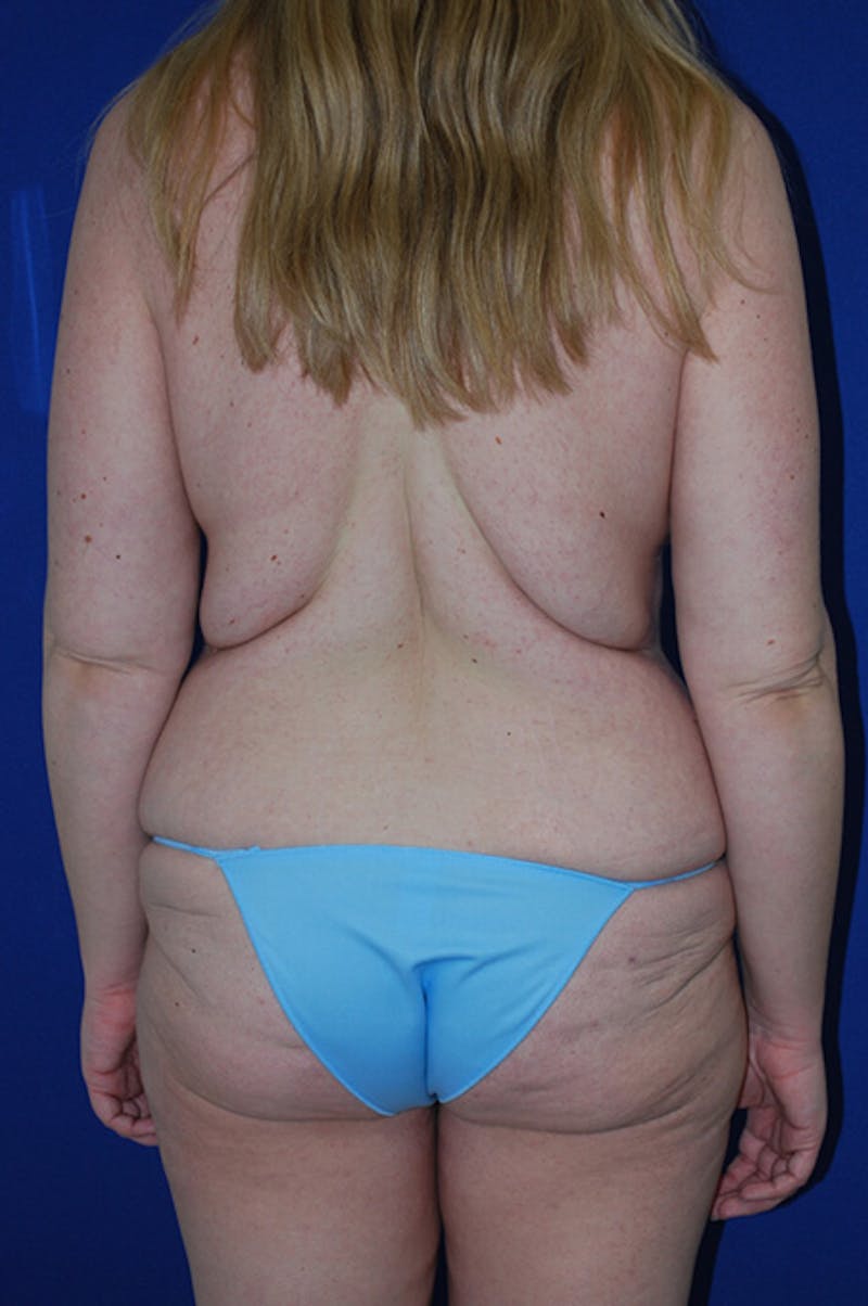 Circumferential Body Lift Before & After Gallery - Patient 298654 - Image 7