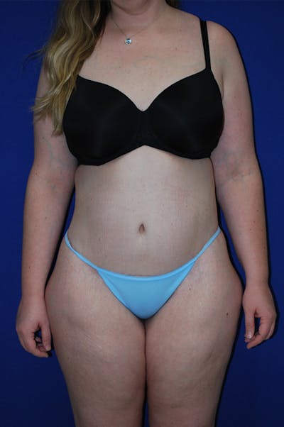 Circumferential Body Lift Before & After Gallery - Patient 298654 - Image 2