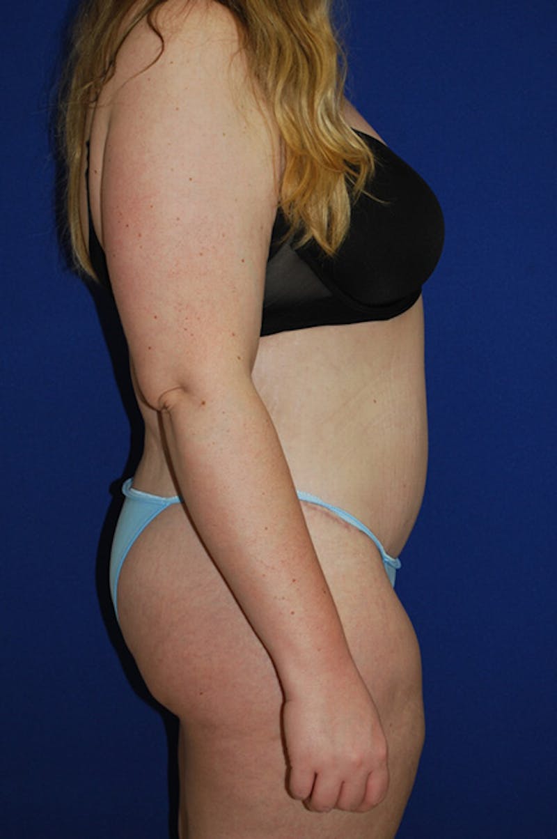 Circumferential Body Lift Before & After Gallery - Patient 298654 - Image 4