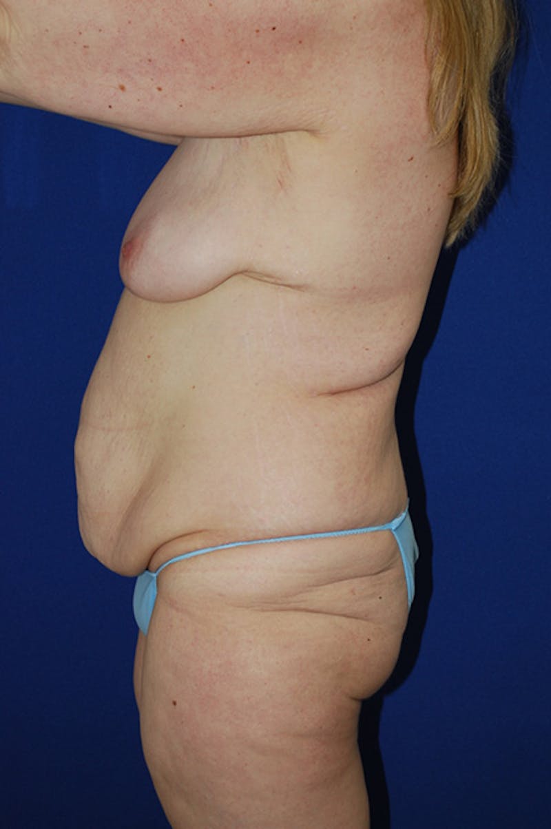 Circumferential Body Lift Before & After Gallery - Patient 298654 - Image 5