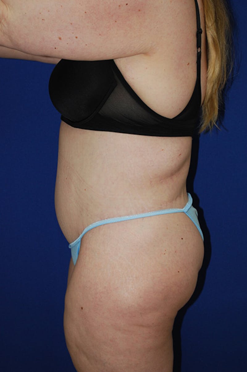 Circumferential Body Lift Before & After Gallery - Patient 298654 - Image 6